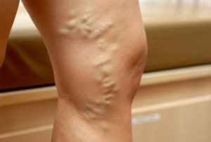  Varicose Veins